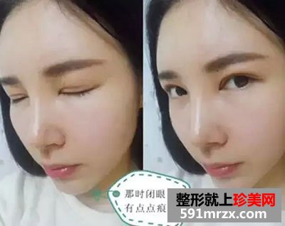 韩式微创双眼皮多少钱