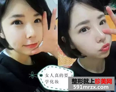 韩式微创双眼皮多少钱