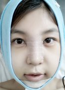 在propose整形医院做的隆鼻效果挺好