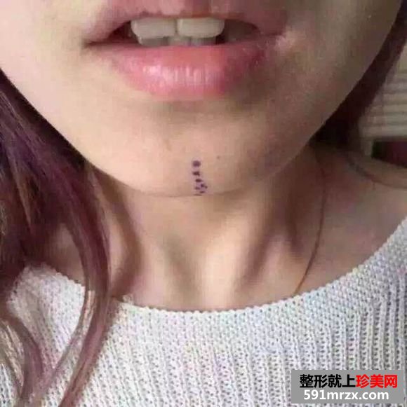 上海美联臣怎么样,玻尿酸垫下巴