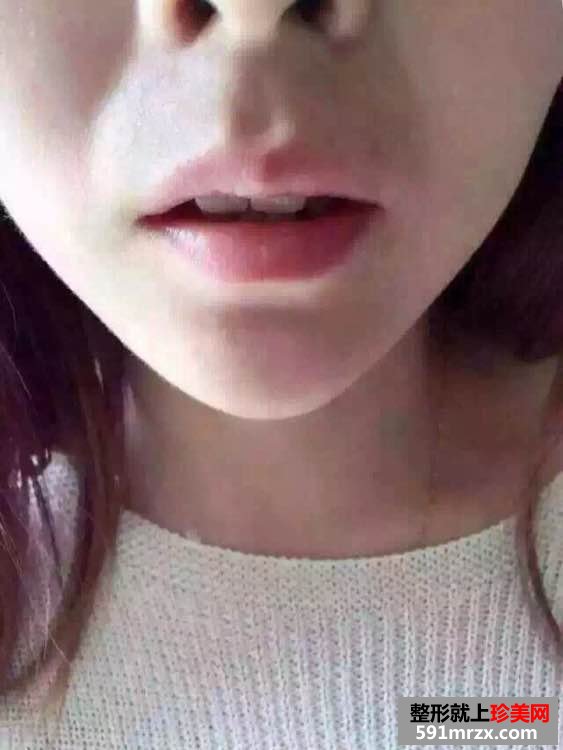 上海美联臣怎么样,玻尿酸垫下巴