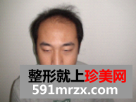 北京无痕植发