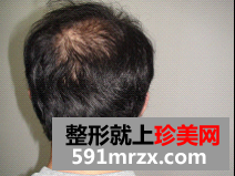 北京无痕植发