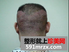 北京无痕植发