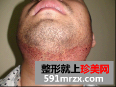 北京无痕植发