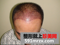 北京无痕植发