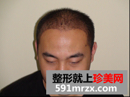 北京无痕植发