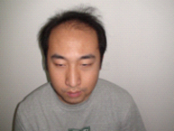 想找女朋友了去现代整形美容医院做的无痕植发