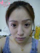 重庆天妃整形医院做的全面部自体脂肪填充案例分享