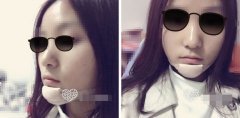 宁波伊美尔整形医院假体隆下巴案例你TM收不收
