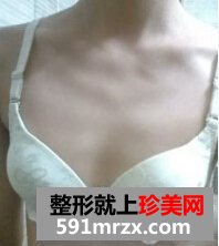 淮南华美整形,自体脂肪移植隆胸术,哎呦不错哦