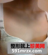 淮南华美整形,自体脂肪移植隆胸术,哎呦不错哦