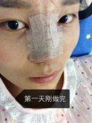 哈尔滨艺星整形医院做的隆鼻鼻子挺了美了