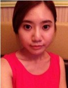 深圳福华整形美容科做隆鼻和额头填充手术
