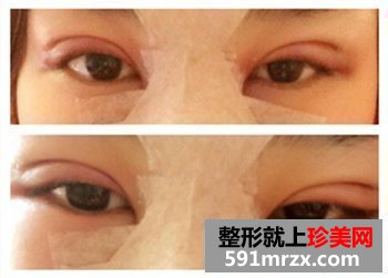 绍兴维美整形美容,伊凡露注射式隆鼻,吸雕双眼皮