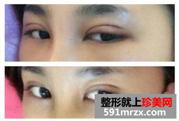 绍兴维美整形美容,伊凡露注射式隆鼻,吸雕双眼皮
