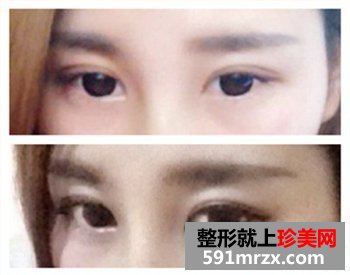 绍兴维美整形美容,伊凡露注射式隆鼻,吸雕双眼皮