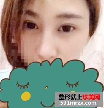 绍兴维美整形美容,伊凡露注射式隆鼻,吸雕双眼皮