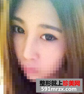 绍兴维美整形美容,伊凡露注射式隆鼻,吸雕双眼皮