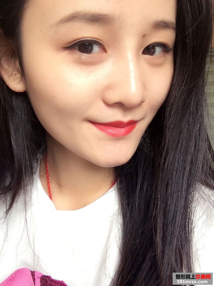 塌鼻子变挺