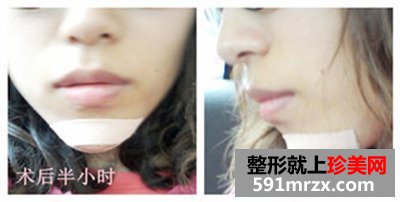 北京八大处,膨体垫下巴