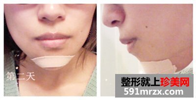北京八大处,膨体垫下巴
