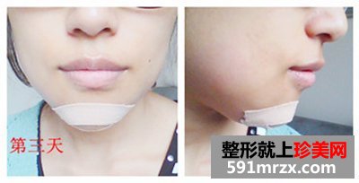 北京八大处,膨体垫下巴