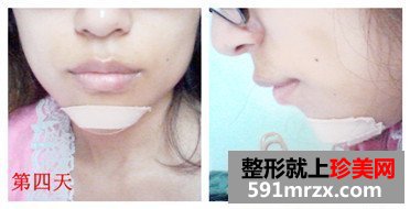 北京八大处,膨体垫下巴