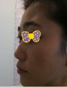 哪家医院做假体隆鼻比较好