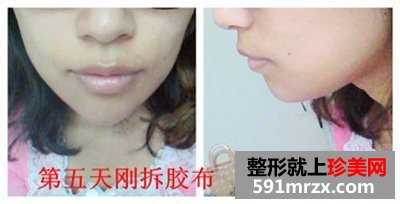 北京八大处,膨体垫下巴