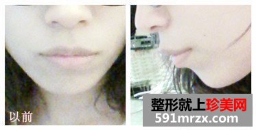 北京八大处,膨体垫下巴