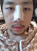 上海九院假体隆鼻价格恢复效果图