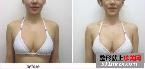 隆胸整形手术过程图介绍 让我自信起来