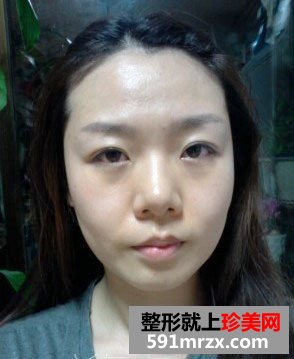北京自体脂肪面部填充