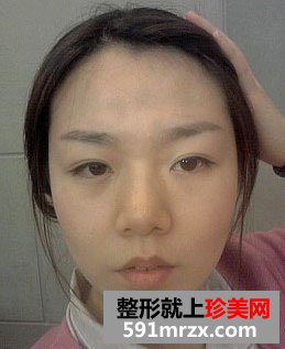 北京自体脂肪面部填充