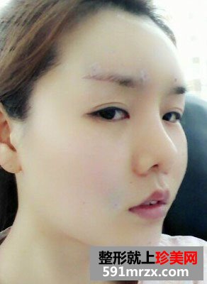 北京自体脂肪面部填充