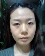北京做的自体脂肪面部填充经历效果