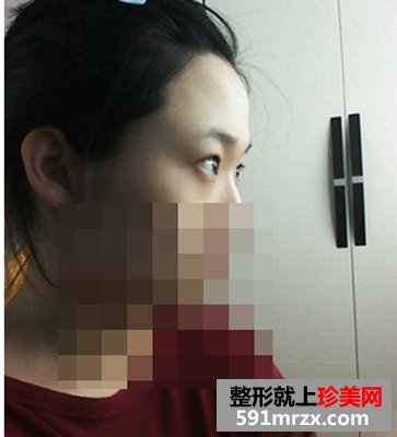 双眼皮埋线几天消肿