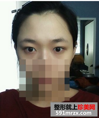 双眼皮埋线几天消肿