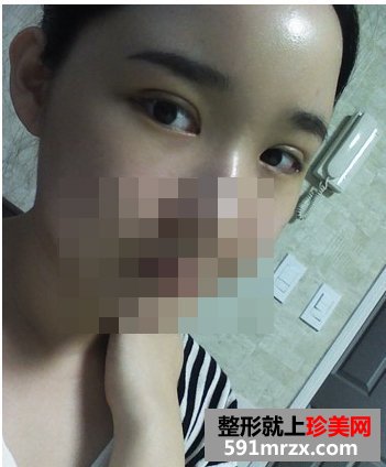 双眼皮埋线几天消肿