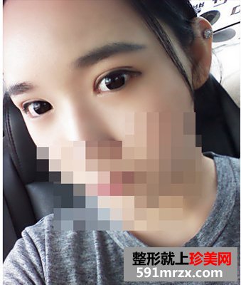 双眼皮埋线几天消肿