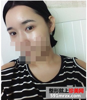 双眼皮埋线几天消肿