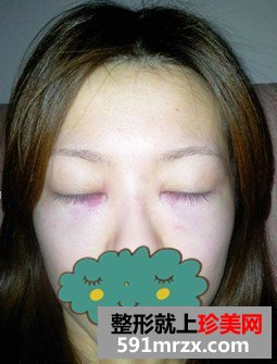被眼袋困扰多年忍无可忍做手术去除