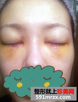 被眼袋困扰多年忍无可忍做手术去除