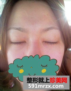 被眼袋困扰多年忍无可忍做手术去除