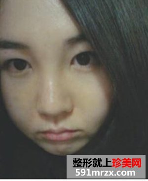 淮南华美整形,膨体假体隆鼻