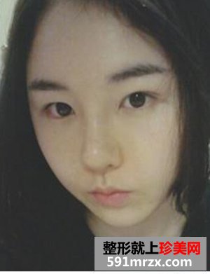 淮南华美整形,膨体假体隆鼻