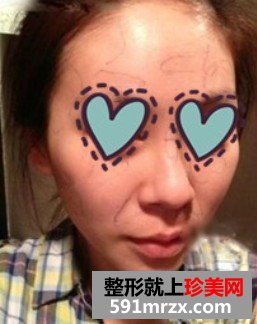 自体脂肪填充