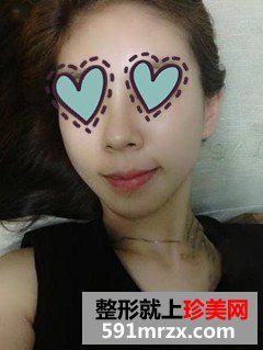 自体脂肪填充
