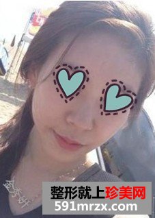 自体脂肪填充